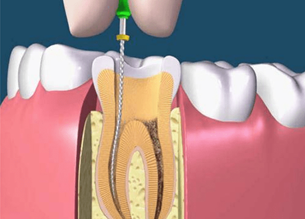 诺贝尔口腔根管治疗