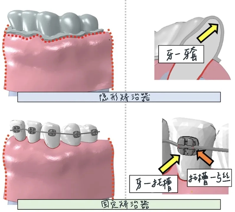 固定矫治器.webp.jpg